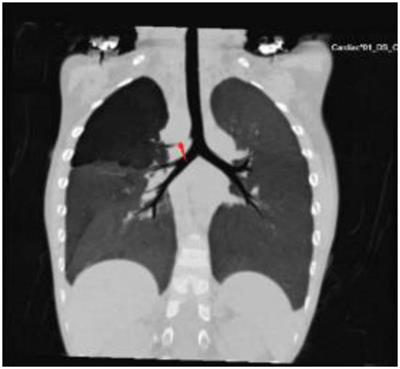 Case report: A rare combination of right aortic arch with right patent ductus arteriosus and right tracheal bronchus causing impaired respiratory function